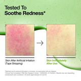 Anua Azelaic Acid 10 Hyaluron Serum | Redness Relief & Pore Care